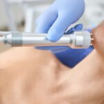 radiofrekwencja mikroigłowa