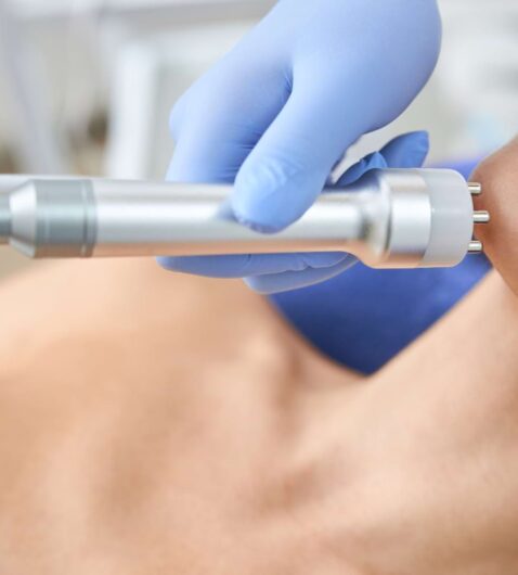 radiofrekwencja mikroigłowa